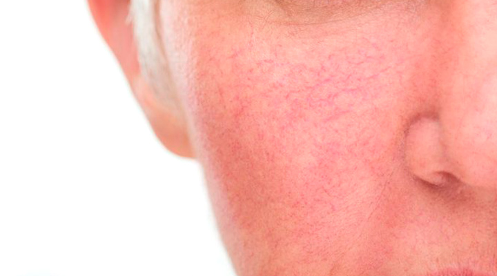 rosacea